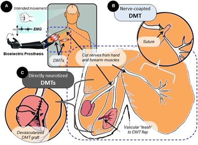 Volume loss during muscle reinnervation surgery is correlated with reduced CMAP amplitude but not reduced force output in a rat hindlimb model